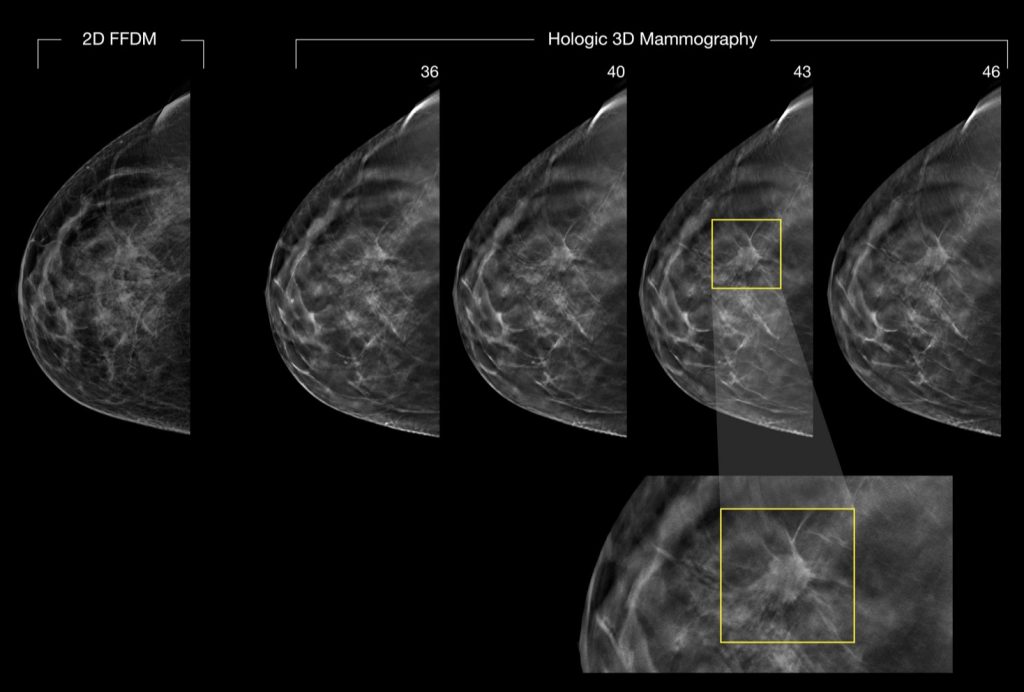 Cpt codes for 3d mammogram   ltm.ybejikloz.asia