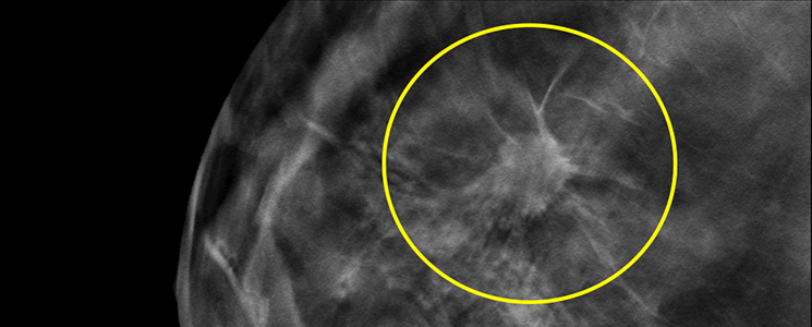 Abnormal Mammograms  Irregular Mammograms - What's Next?