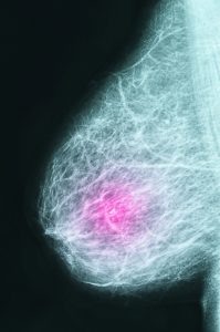 abnormal mammogram