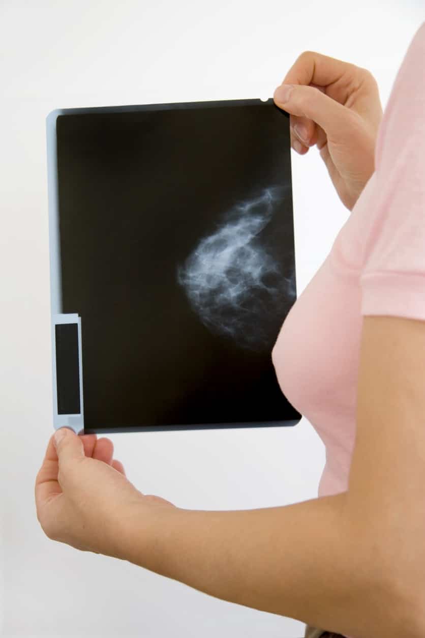 woman holding mammogram x-ray